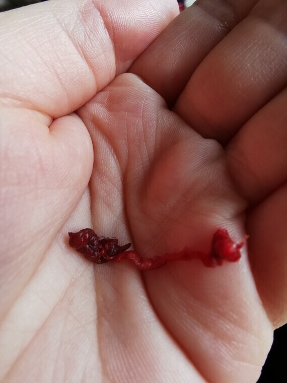 Warning Pictures Is This A Very Early Miscarriage