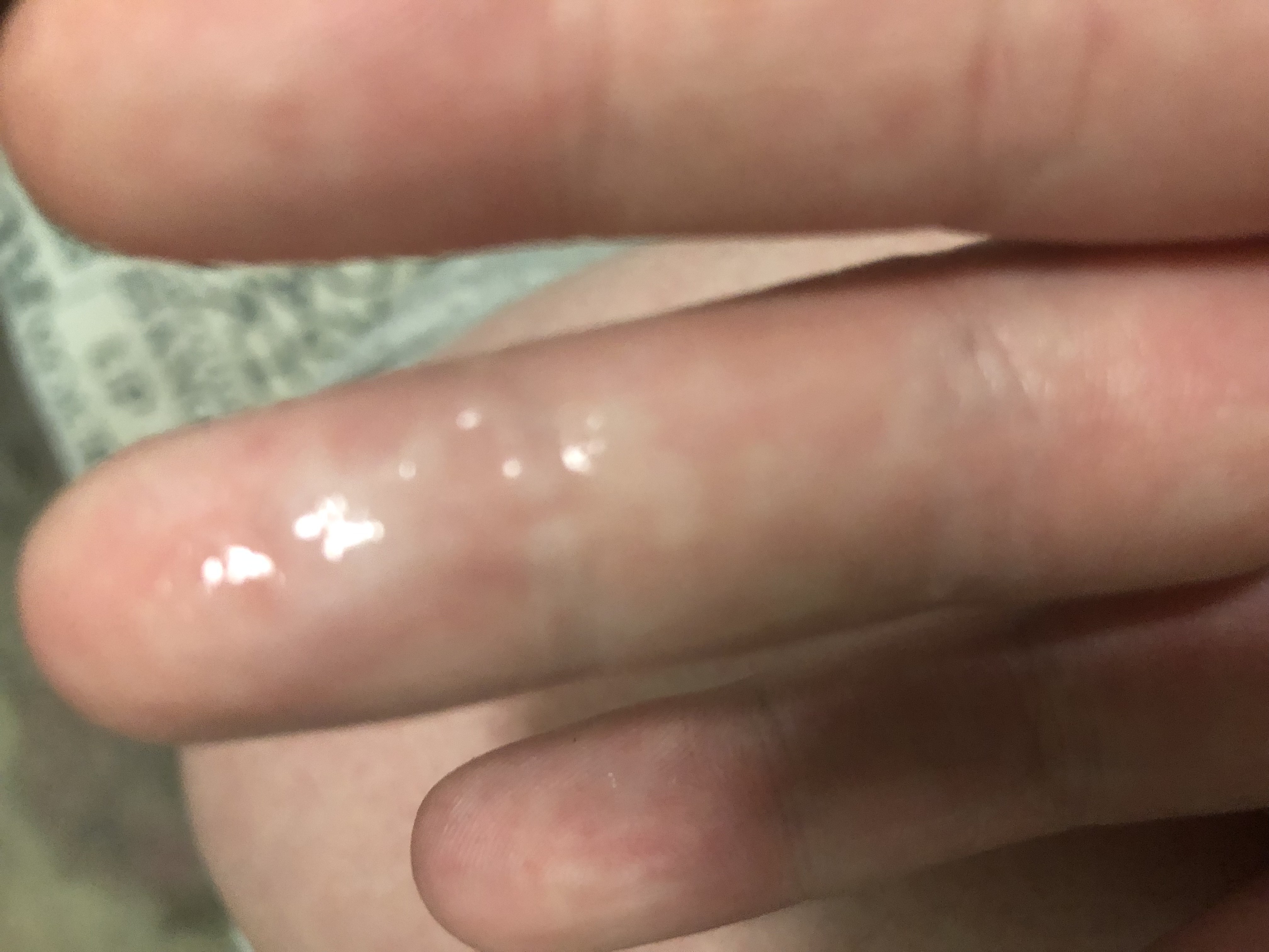 pics Tooth Abscess While Pregnant Netmums welcome to dangerous neoseeker xyz