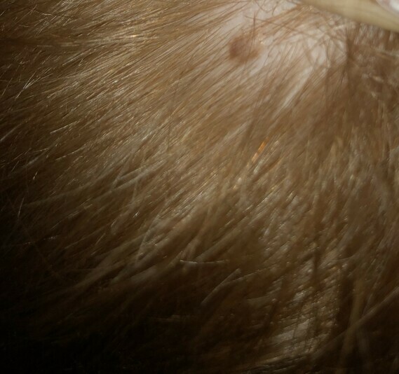 Mole on sons head