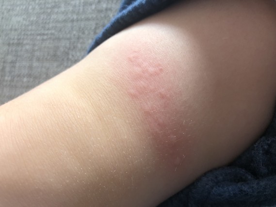 Advice Rash And Sore Throat