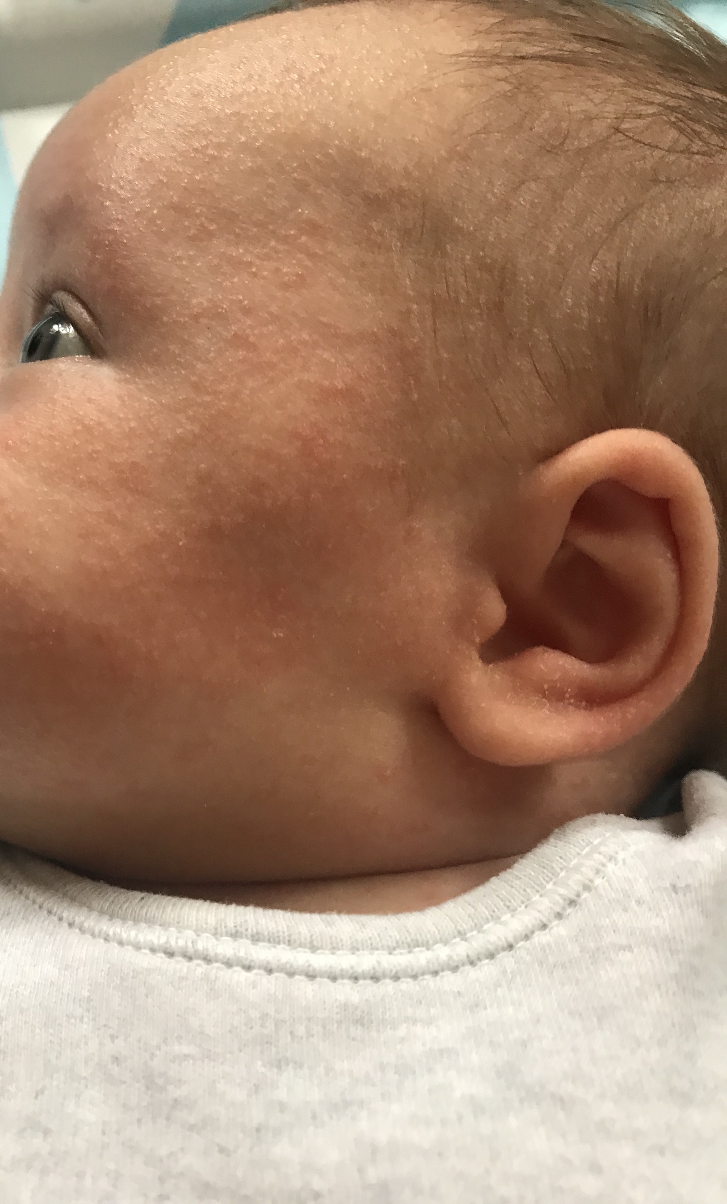 baby acne newborn rash eczema netmums